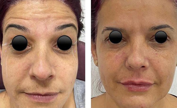 Antes e depois de botox, preenchimento com ácido hialurônico de olheiras e contorno superior do lábio