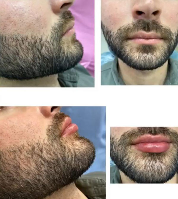 Lábios masculinos, resultado imediato e satisfatório