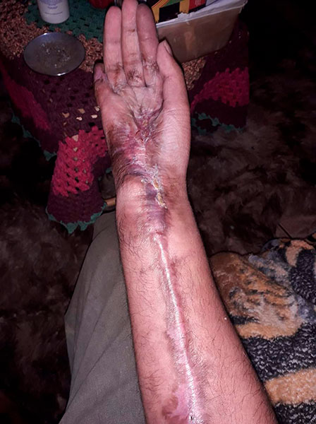 divulgação - Mão de Celso após acidente de trabalho - Foto: Divulgação/Arquivo Pessoal