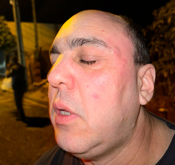 divulgação - Renato ficou com hematomas no rosto após briga - Foto: Divulgação