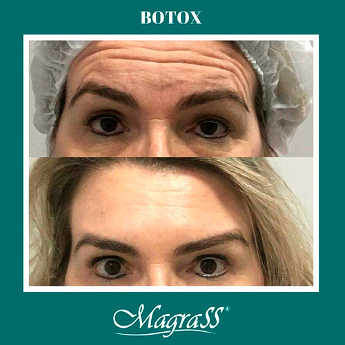 Divulgação - O Botox é ideal para quem quer diminuir as marcas de expressão - Foto: Divulgação