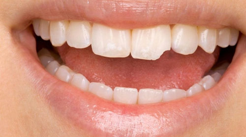 Dentes frágeis podem se recuperar, sim!