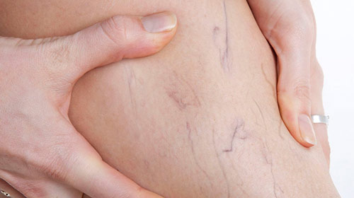 Varizes: saiba mais sobre a doença e período ideal para o tratamento