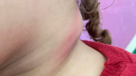 Segunda a mãe de Ana Lívia, o caroço no pescoço no pescoço da filha começou a aparecer entre os dias 12 e 14 de maio - FOTO: Redes Sociais