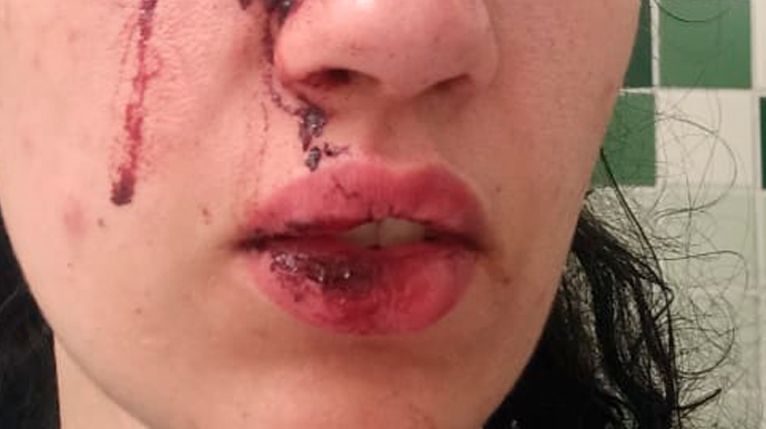 Bombeiro agride ex-mulher em Assis, é preso em flagrante e solto após audiência de custódia Mulher foi atendida na UPA de Assis - FOTO: Enviada ao Portal AssisCity