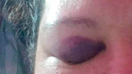 Mulher ficou com diversos hematomas pelo corpo após as agressões - FOTO: Enviada ao Portal AssisCity